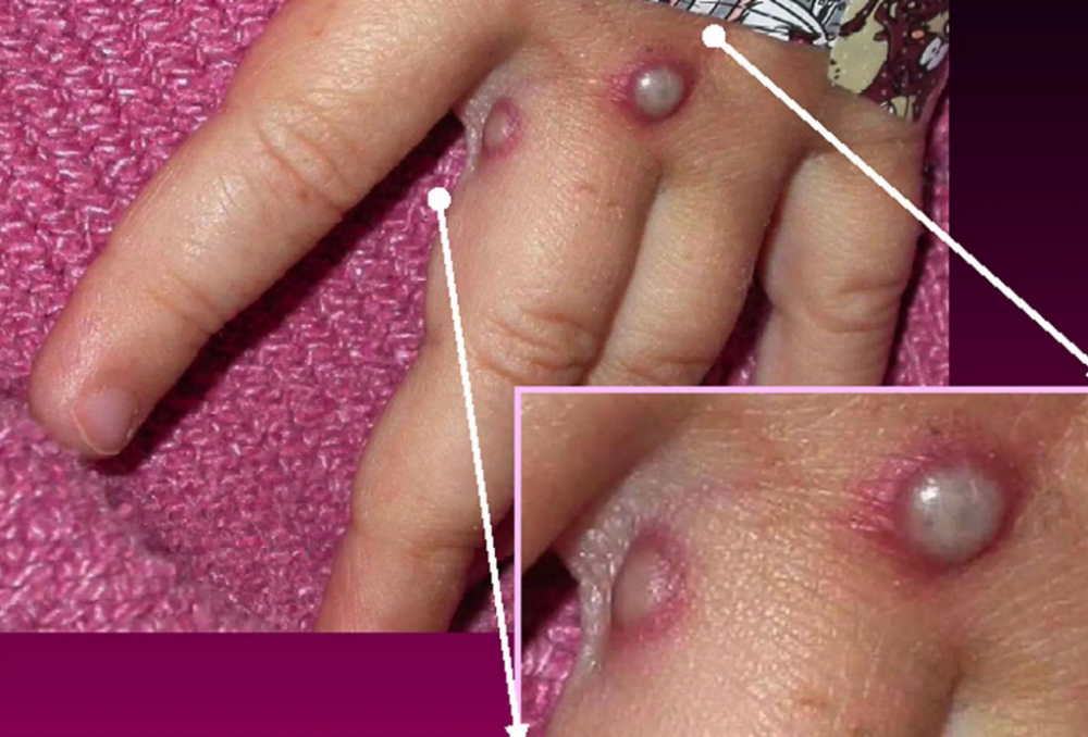 Tăng cường giám sát phòng chống bệnh đậu mùa khỉ