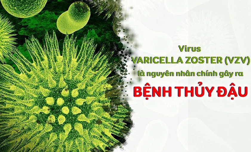 Ghi nhận 2 ổ dịch thủy đậu tại TP. Buôn Ma Thuột và huyện Lắk